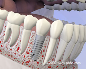 Denture
