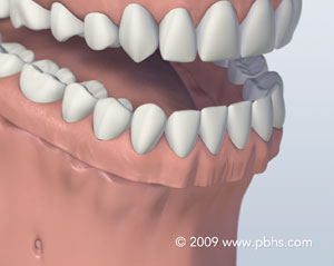 Metal Partial