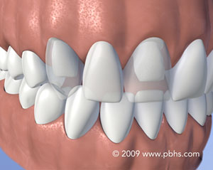 Tooth Replacement